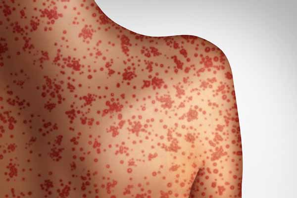 Measles rash